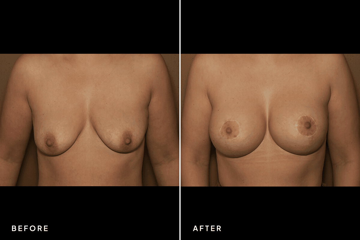 New Horizons Breast Gallery | Breast Lift With Implants | 6952-mastopexy | A Front