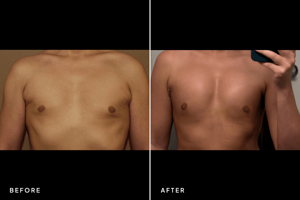 New Horizons Breast Gallery | Pec Implants | 7060-pec-implants | A Front