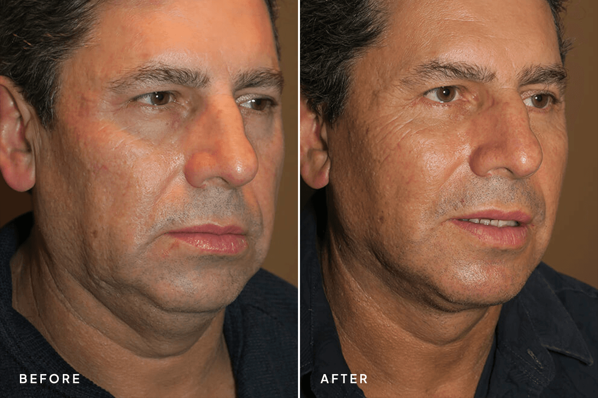 New Horizons Face Gallery | Male Face Neck Lift | 6867-neck-lift | C Angle