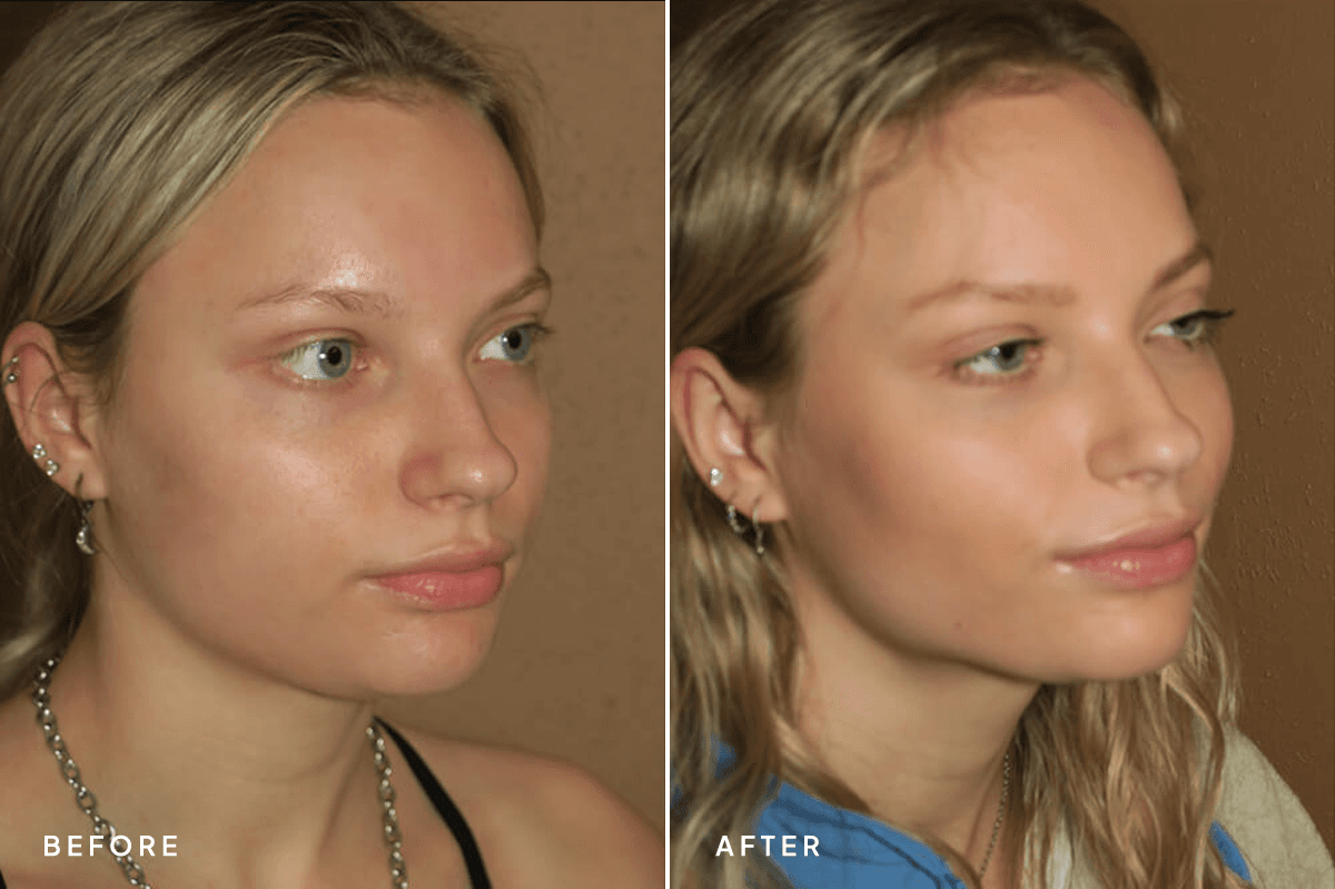 New Horizons Face Gallery | Buccal Fat Pad Removal | 6898-neck-liposuction | B Side