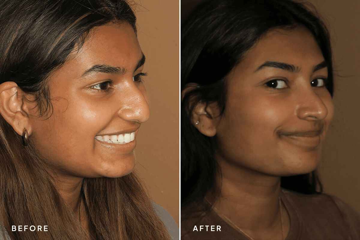 New Horizons Face Gallery | Rhinoplasty | 6955-rhinoplasty | C Angle