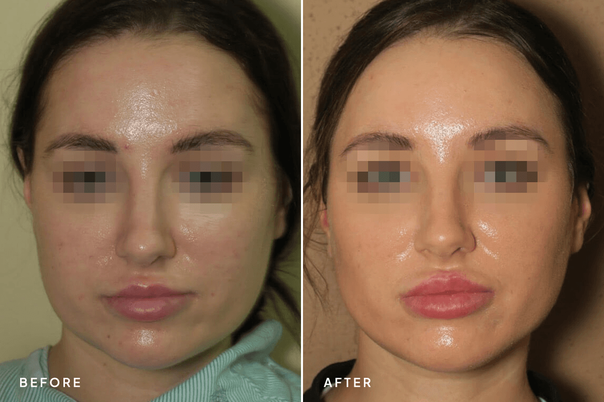 New Horizons Face Gallery | Buccal Fat Pad Removal | 72 liposuction | A Front