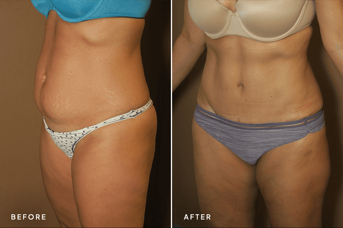 New Horizons Body Gallery | Tummy Tuck | 55-abdominoplasty | B Side