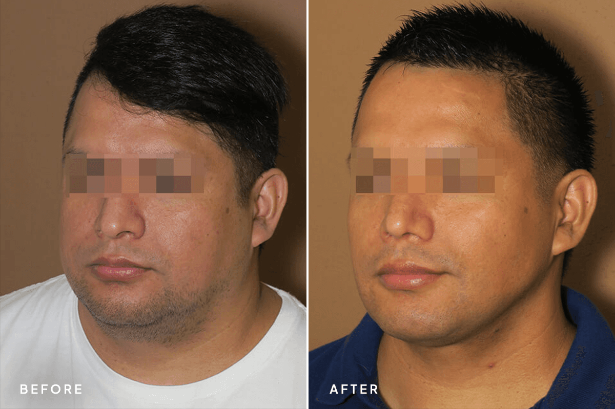 New Horizons Face Gallery | Buccal Fat Pad Removal | 6612 face-combo | B Side