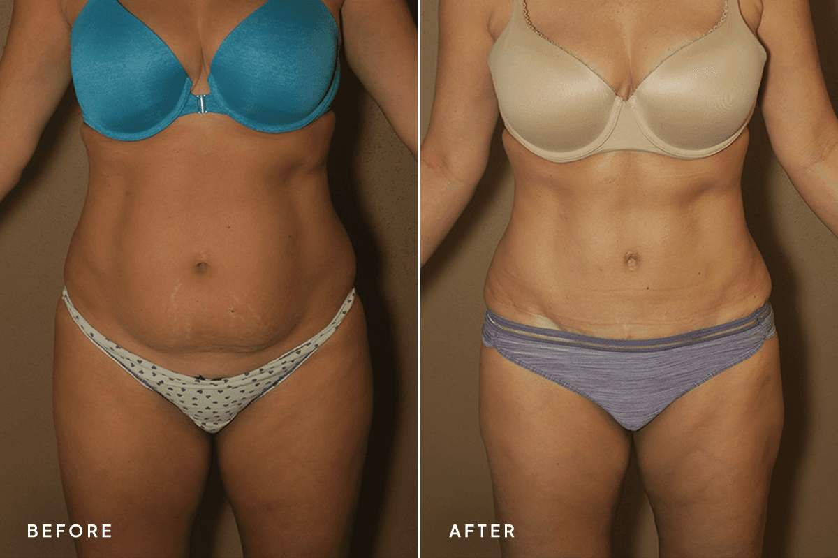 New Horizons Body Gallery | Tummy Tuck | 55-abdominoplasty | A Front