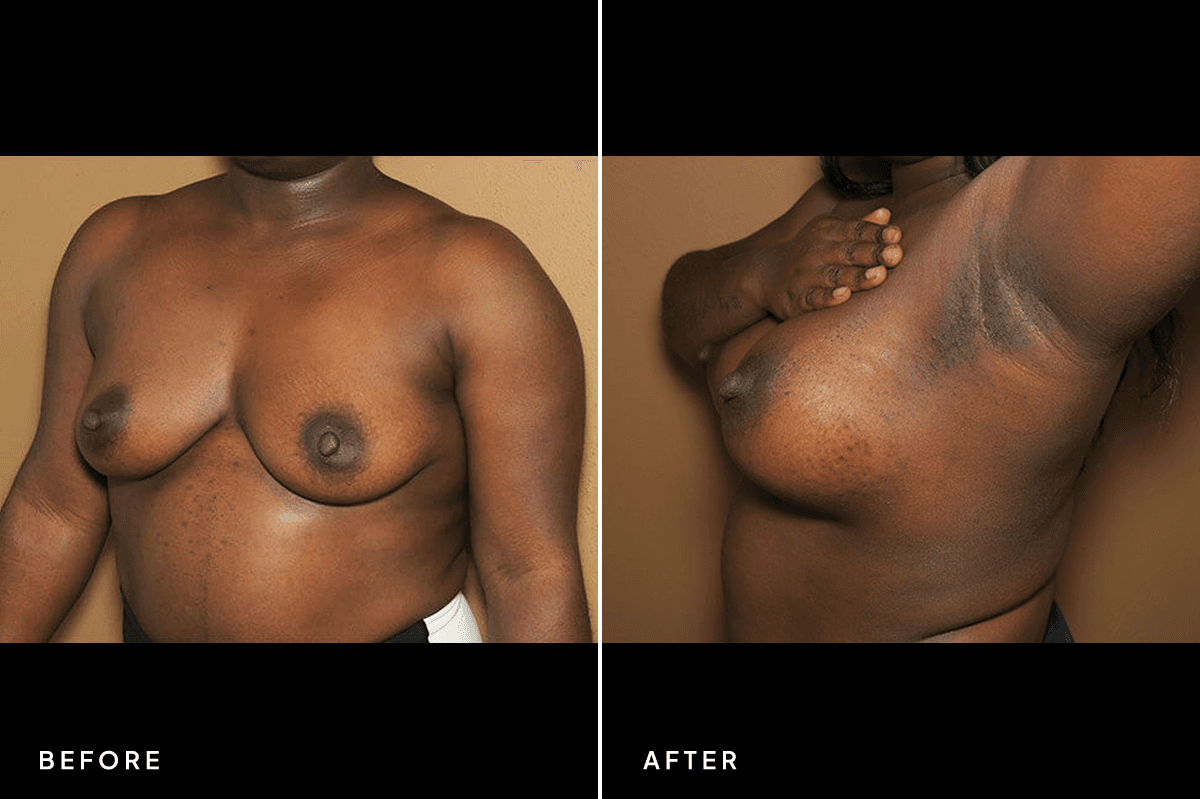 New Horizons Breast Gallery | Breast augmentation - All Endoscopic | 320-breast-augmentation | D Angle