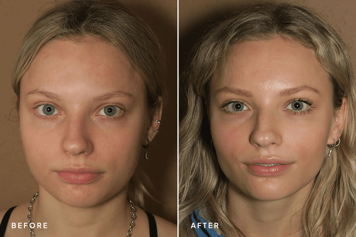 New Horizons Face Gallery | Buccal Fat Pad Removal | 6898-neck-liposuction | A Front