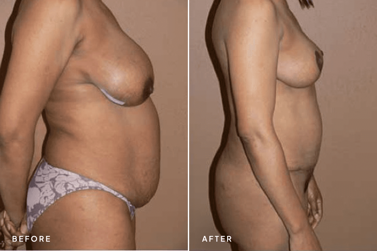 New Horizons Body Gallery | Tummy Tuck | 14-tummy-tuck-abdominoplasty | B Side