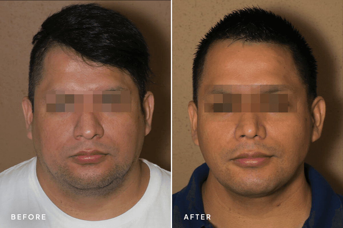 New Horizons Face Gallery | Buccal Fat Pad Removal | 6612 face-combo | A Front