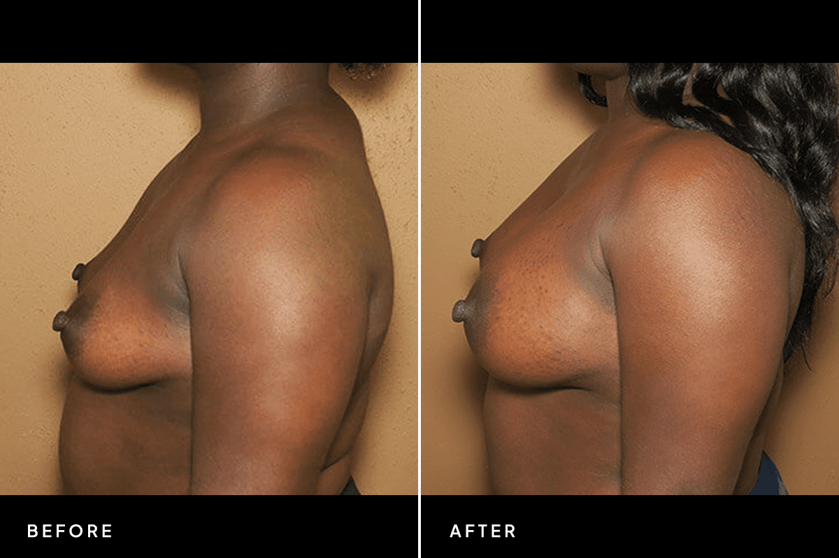 New Horizons Breast Gallery | Breast augmentation - All Endoscopic | 320-breast-augmentation | C Angle