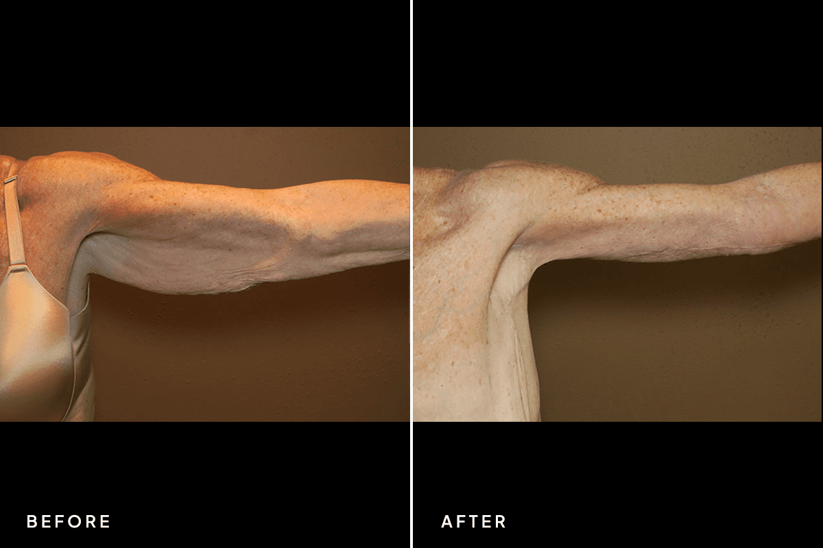 New Horizons Body Gallery | Weight Loss | 32-armlift | A Left