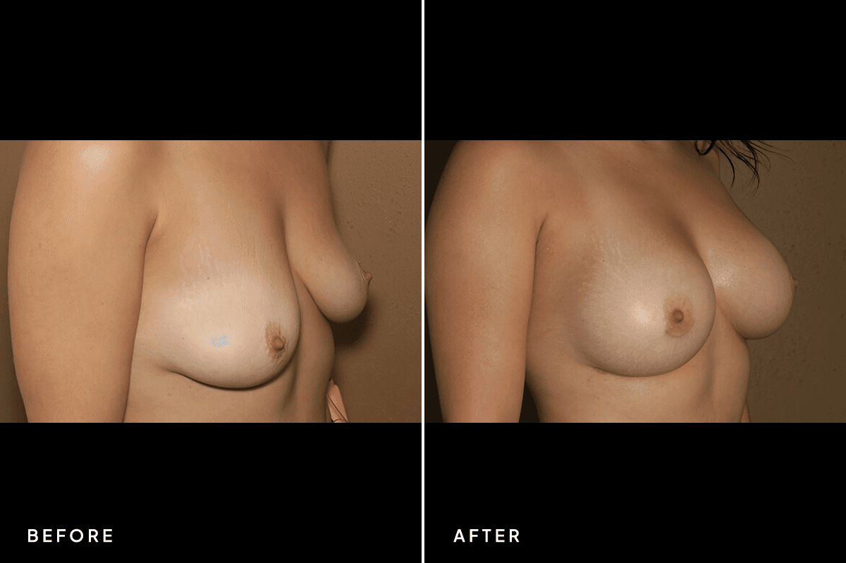 New Horizons Breast Gallery | Breast augmentation - All Endoscopic | 6967-breast-augmentation | B Side