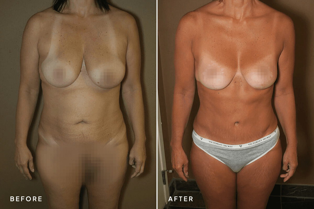 New Horizons Body Gallery | Mommy Makeover | 61-mommy-makeover | A Front