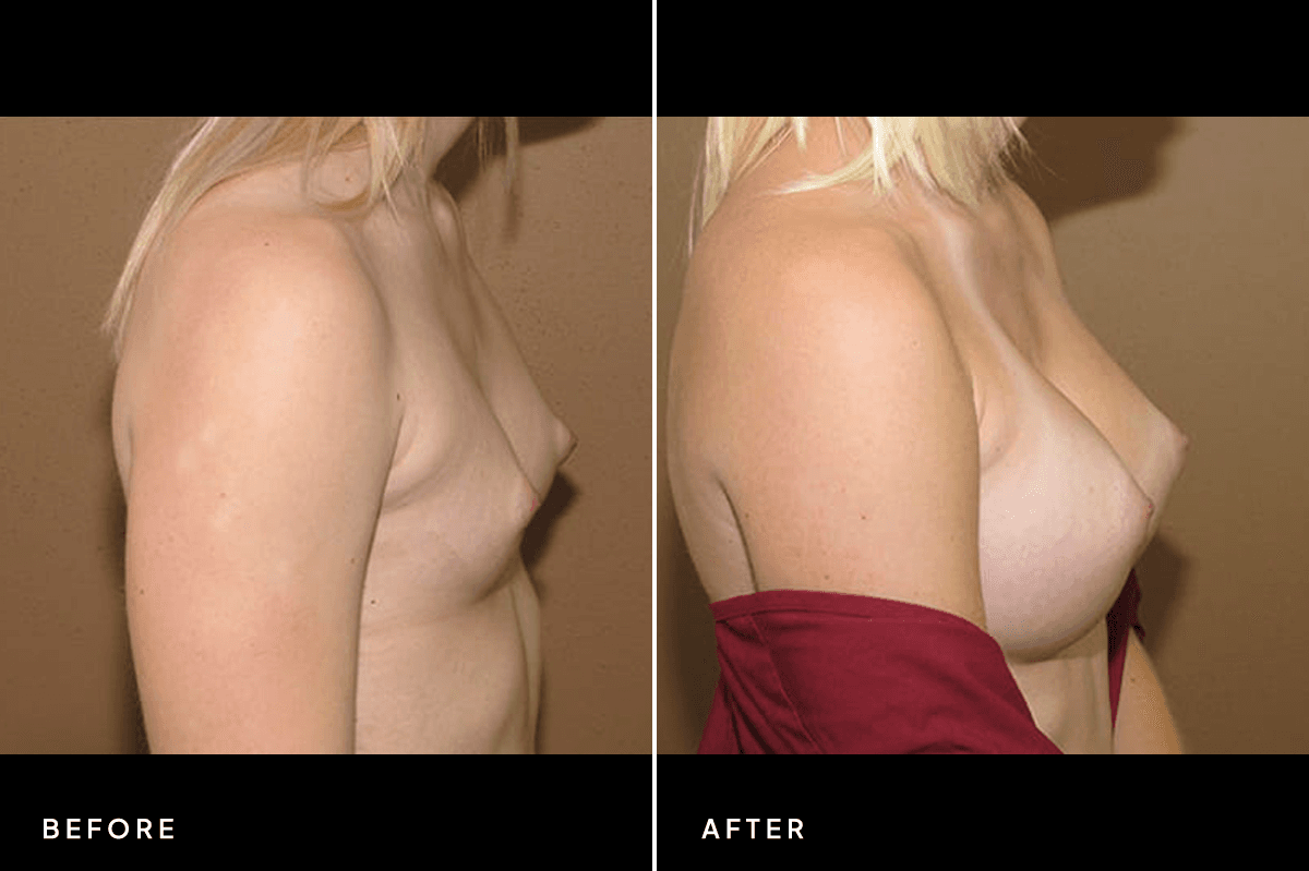 New Horizons Breast Gallery | Breast augmentation - All Endoscopic | 7210-breast-augmentation | B Side