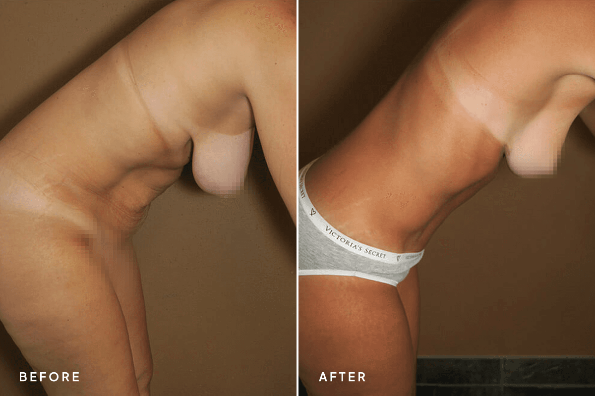 New Horizons Body Gallery | Mommy Makeover | 61-mommy-makeover | D Angle