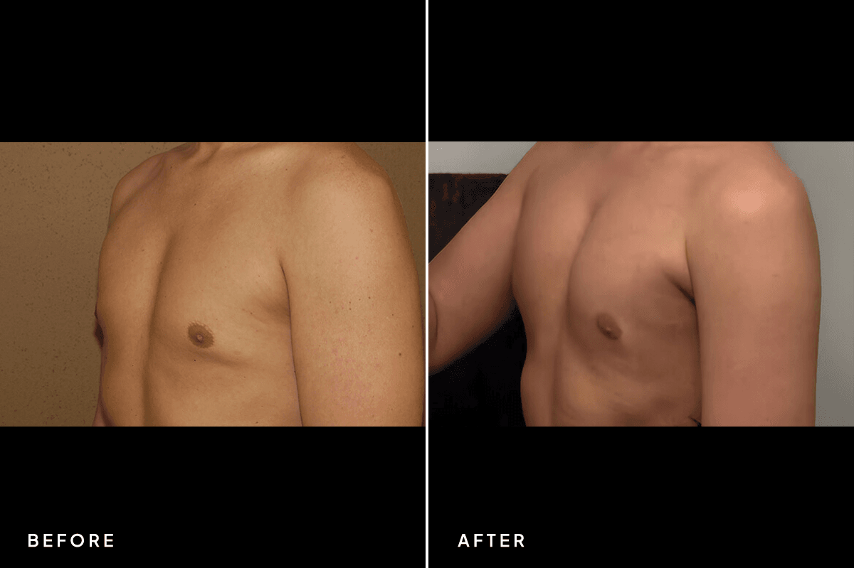 New Horizons Breast Gallery | Pec Implants | 7060-pec-implants | C Angle