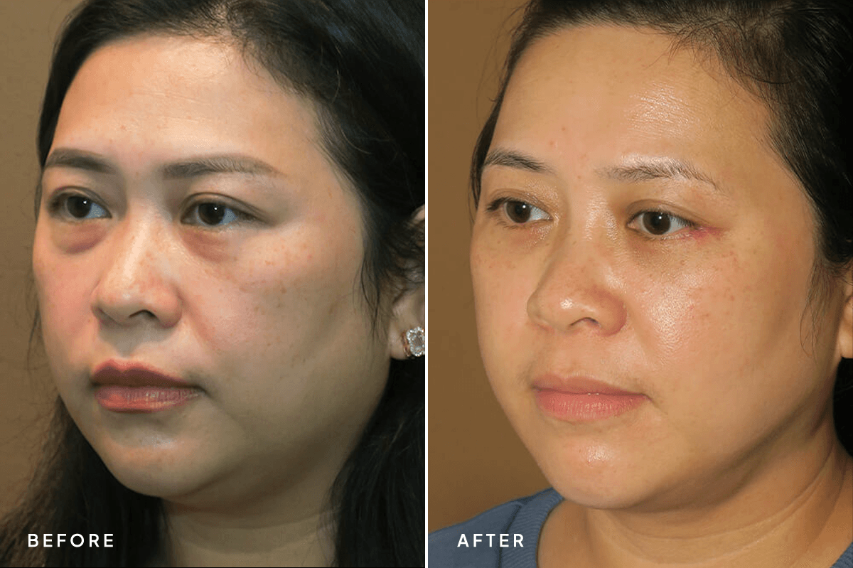 New Horizons Face Gallery | Buccal Fat Pad Removal | 6767-blepharoplasty | B Side