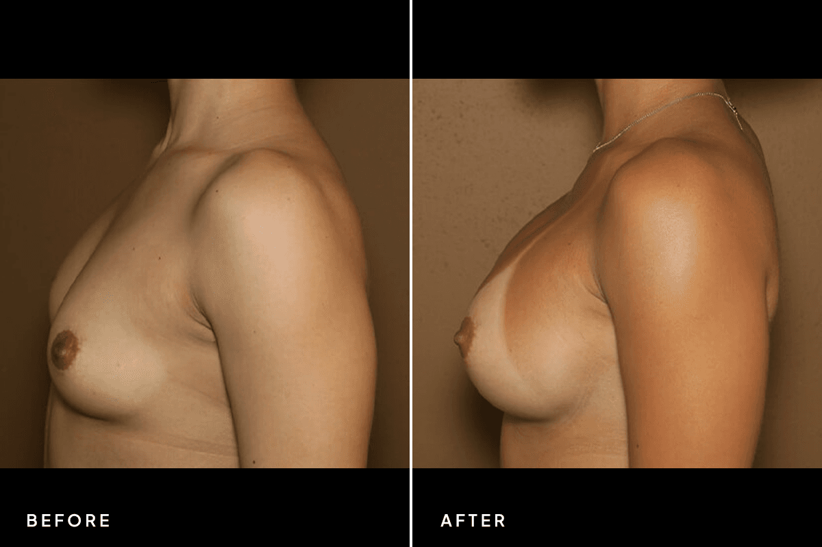 New Horizons Breast Gallery | Breast augmentation - All Endoscopic | 6240-bilateral-breast-augmentation | B Side