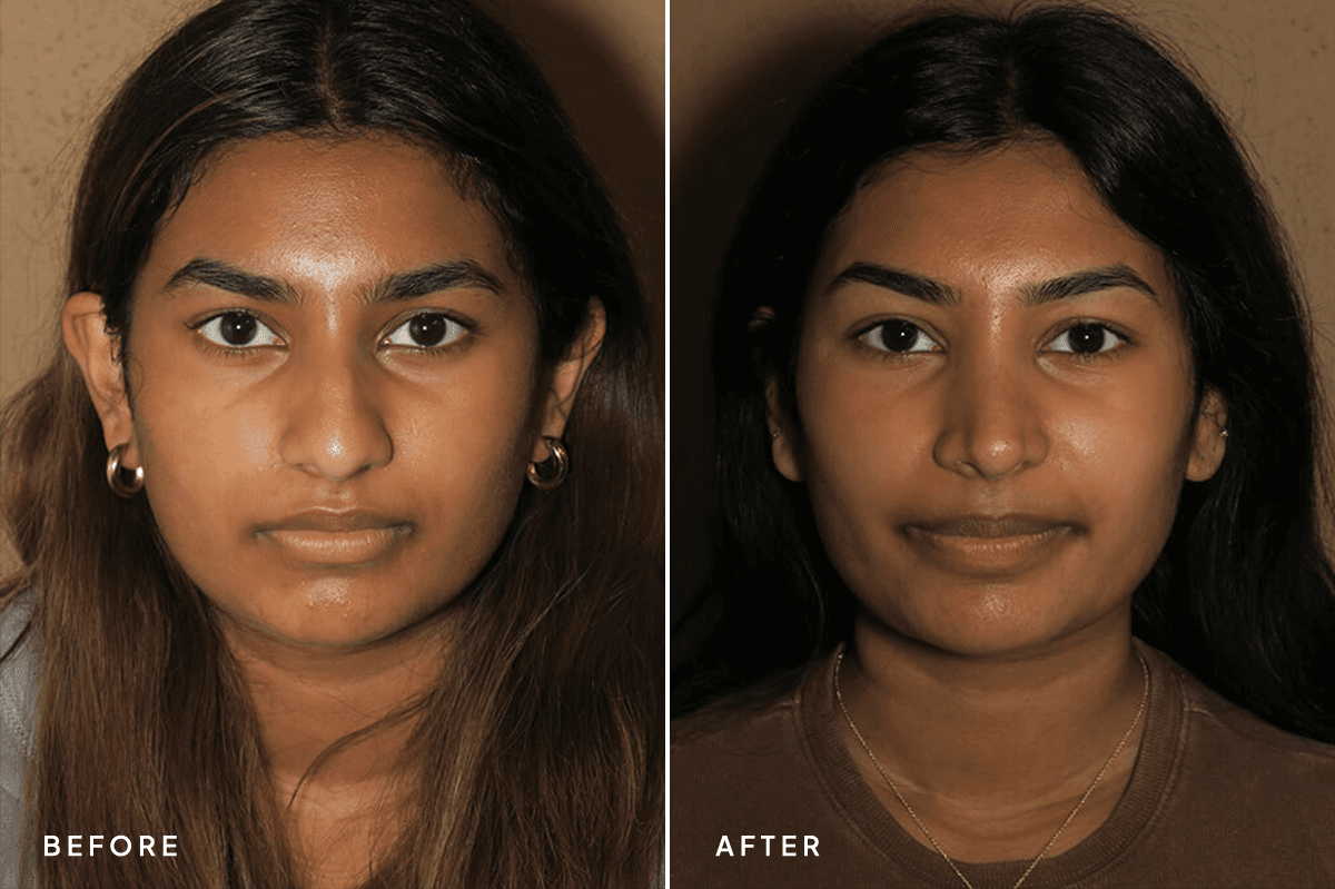 New Horizons Face Gallery | Rhinoplasty | 6955-rhinoplasty | A Front