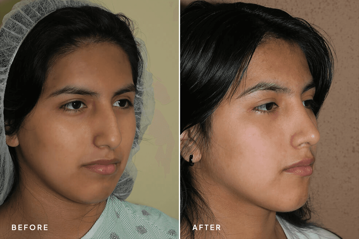New Horizons Face Gallery | Rhinoplasty | 6976-rhinoplasty | C Angle