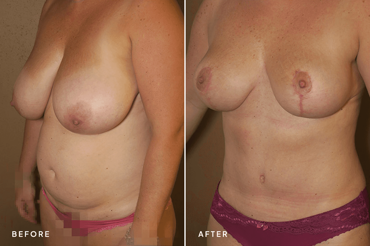 New Horizons Body Gallery | Mommy Makeover | 56-mommy-makeover | C Angle
