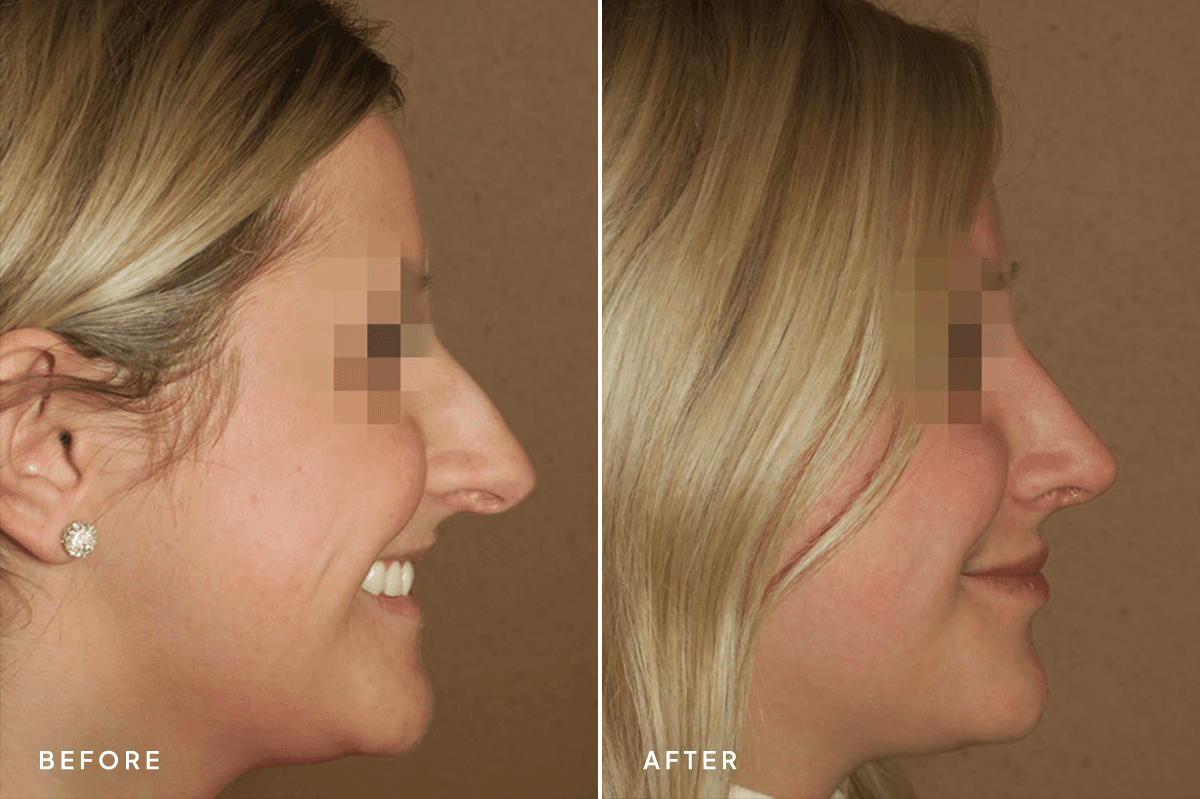 New Horizons Face Gallery | Rhinoplasty | 414-rhinoplasty | B Side