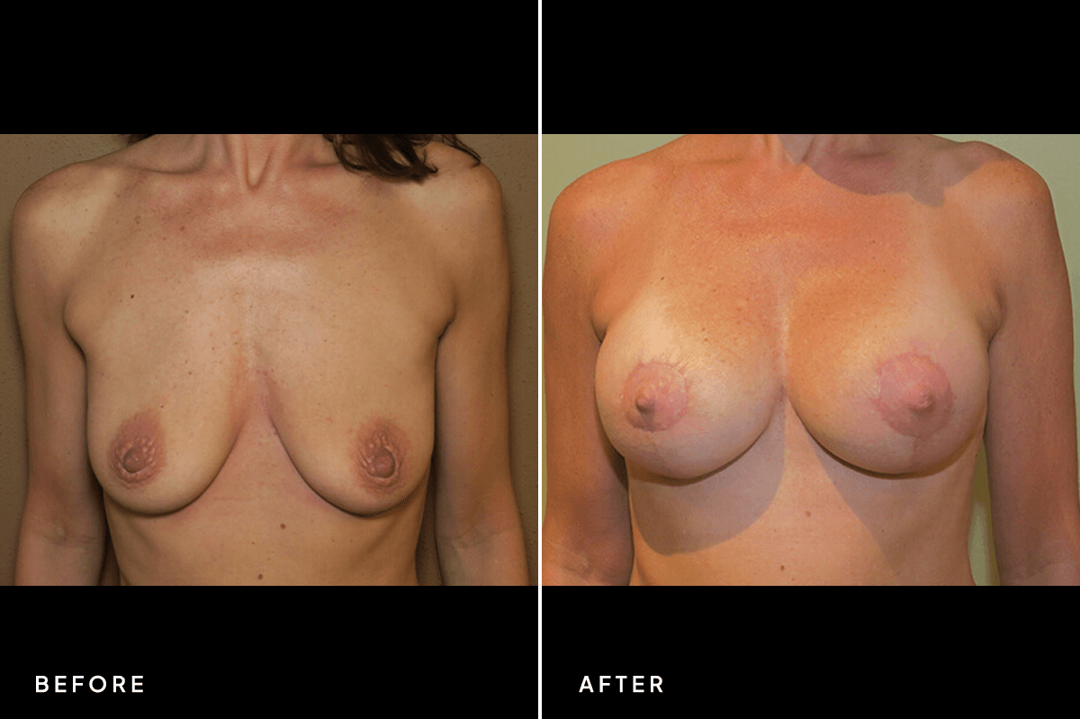 New Horizons Breast Gallery | Breast Lift With Implants | 7084-breast-lift | A Front