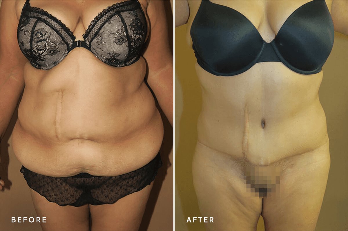 New Horizons Body Gallery | Weight Loss | 7081-belt-lipectomy | A Front