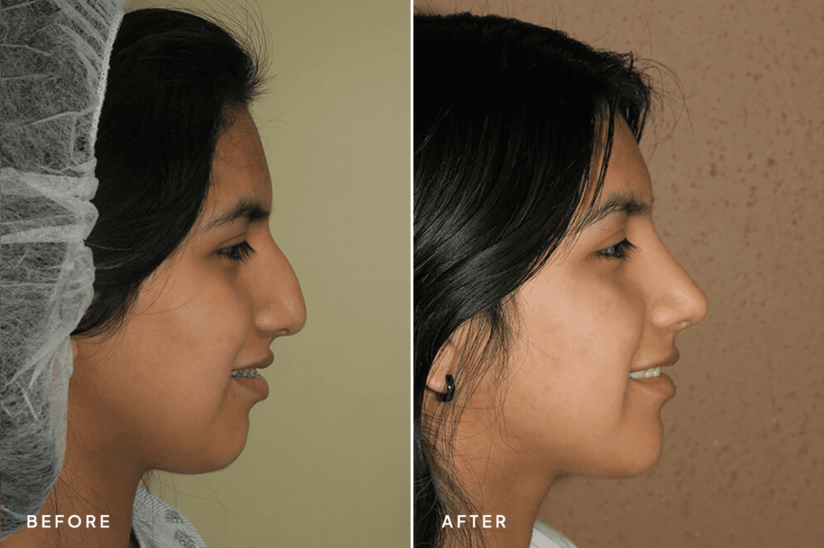New Horizons Face Gallery | Rhinoplasty | 6976-rhinoplasty | B Side