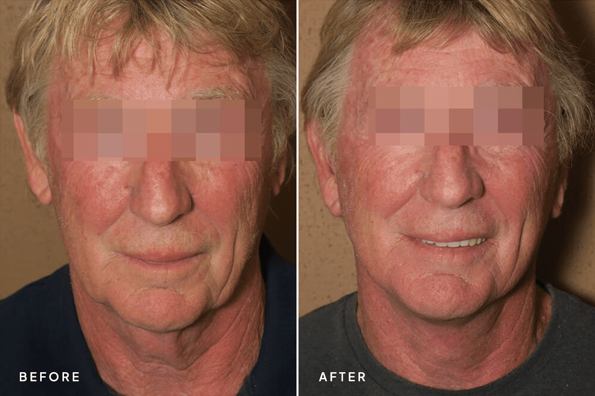 New Horizons Face Gallery | Male Face Neck Lift | 6633-neck-lift | A Front
