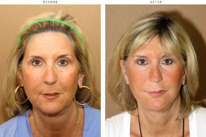 face-lift-before-and-after-pictures-20