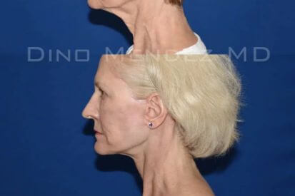 Necklift-1D-jpg