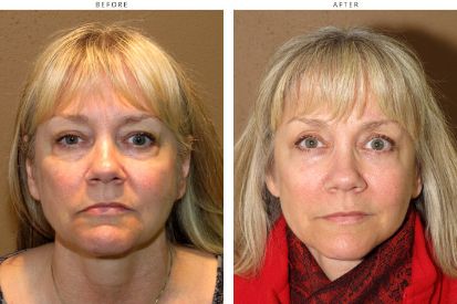 mid-face-lift-before-and-after-pictures-04