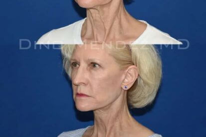 Necklift-1C-jpg