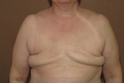 breast-reconstruction-before-and-after-pictures-17