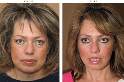 face-lift-before-and-after-pictures-16