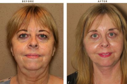 complex-facial-rejuvenation-before-and-after-pictures-16