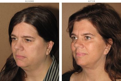 face-lift-before-and-after-pictures-11
