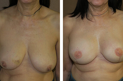 Bilateral-Reconstruction-after-Mastectomy-1