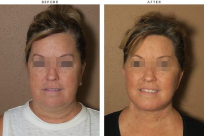 Deep-face-facelift-and-buccal-fat-pad-excision-1-1