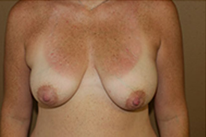 breast-reconstruction-56-copy