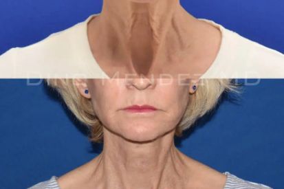 Necklift-1B-jpg