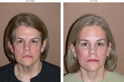 face-lift-before-and-after-pictures-08