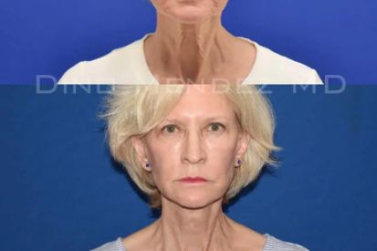 Necklift-1A-jpg