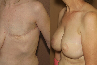 breast-reconstruction-before-after-3509-02