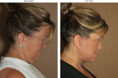 Deep-face-facelift-and-buccal-fat-pad-excision-2-1